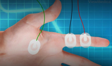 Image of hand with EMG pads and leads attached